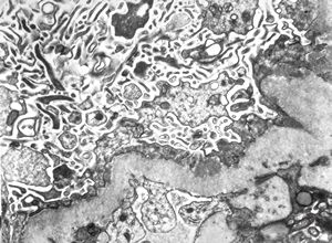 M,39y. | membranous glomerulopathy